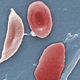 A colorized microscope image shows a sickle cell, left, and normal red blood cells of a patient with sickle cell anemia.